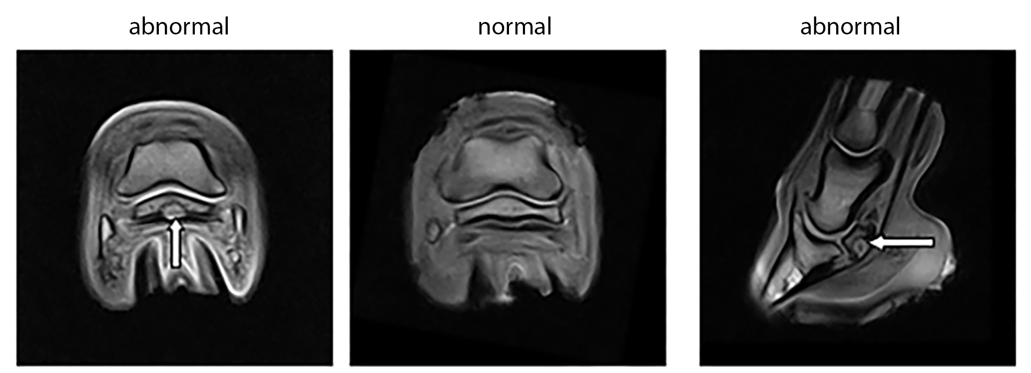 MRI of a navicular cyst
