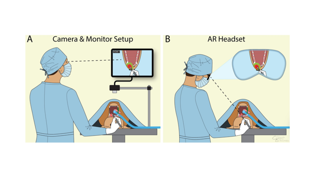 Diagram: surgeon viewing laparoscopic monitor (left) and using AR headset with overlay (right)